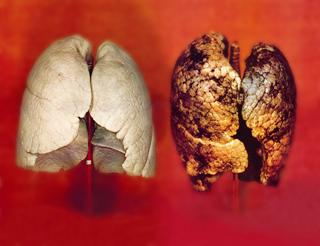 Ukraine 2012 Health Effects lung - diseased organ, lung cancer, gross